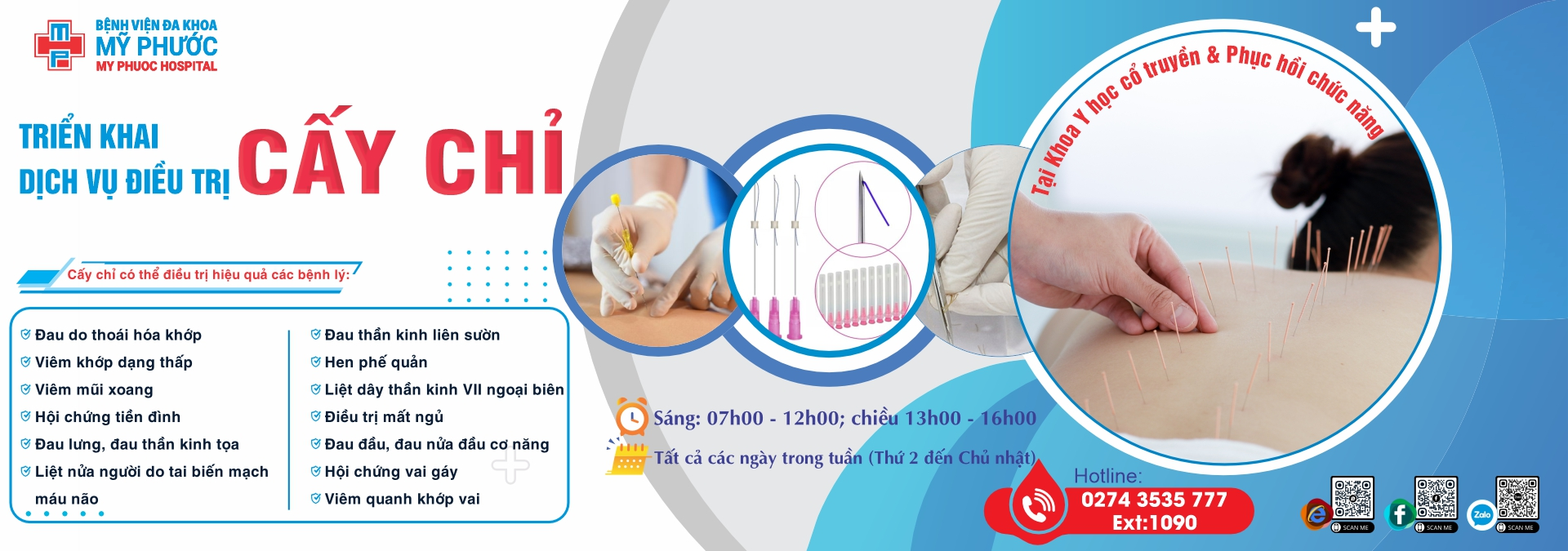 Triển khia dịch vụ điều trị Cấy Chỉ trong YHCT&PHCN